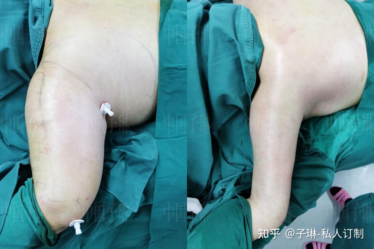 威塑手臂吸脂改善拜拜肉