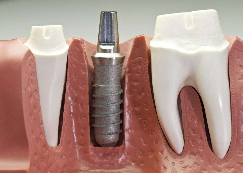 成都种牙贵不贵成都微创即刻种植牙医院有哪些成都德国icx种植体品牌
