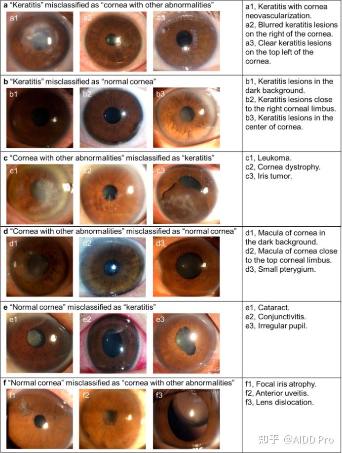国内研发利用人工智能预防角膜炎导致的失明