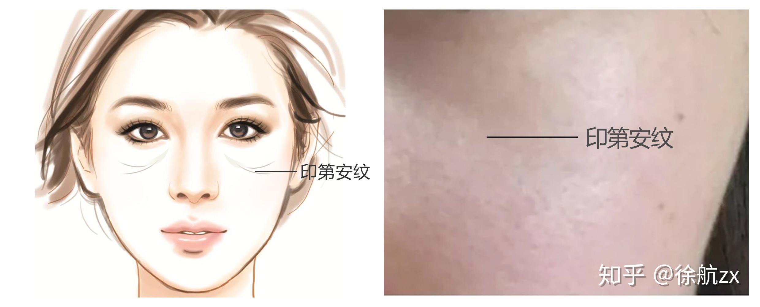 印第安纹是如何出现的又该如何处理