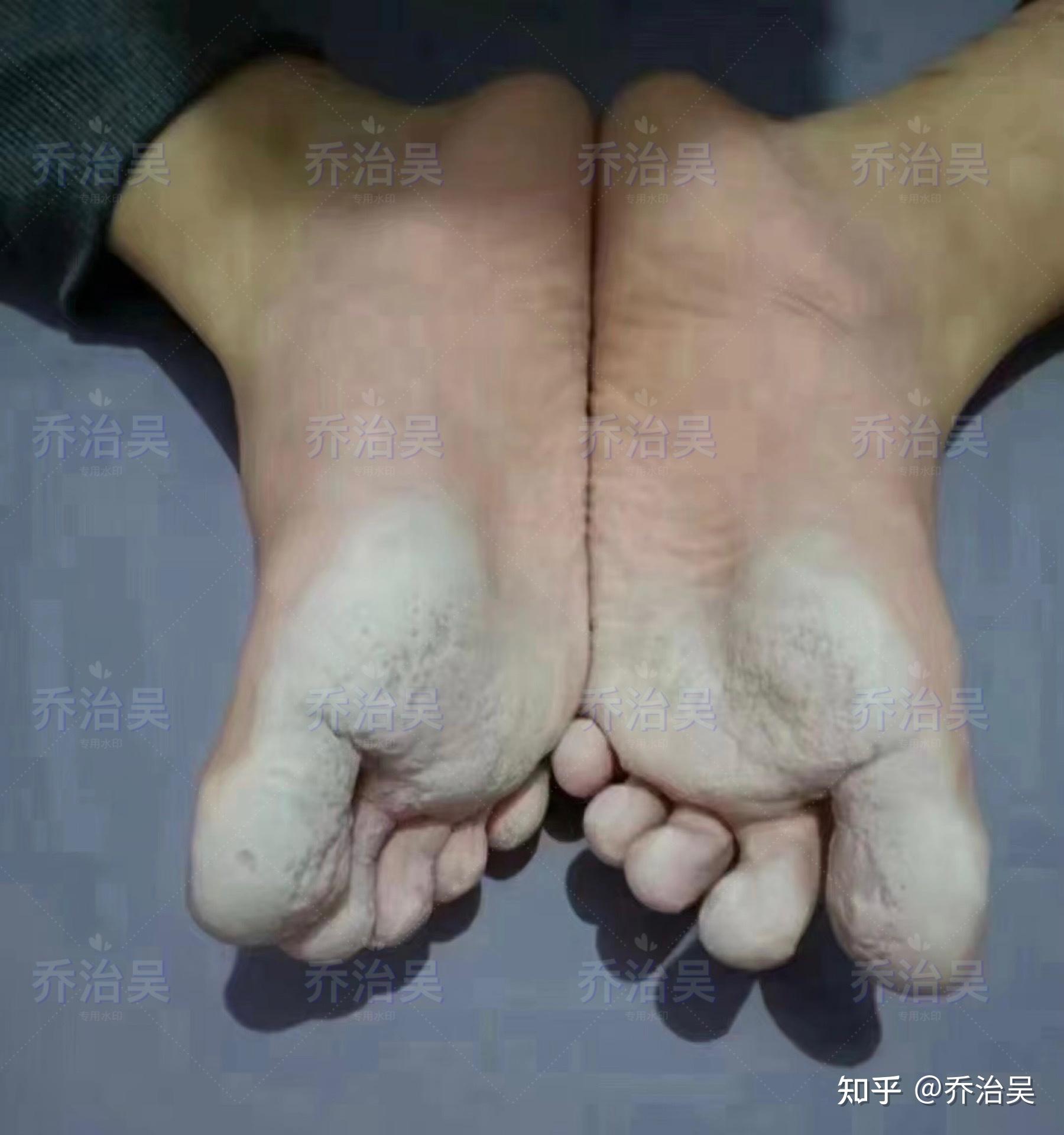 脚底发白,多汗,会出现一个一个的小坑,跟蜂窝似的,医学临床上称为:窝