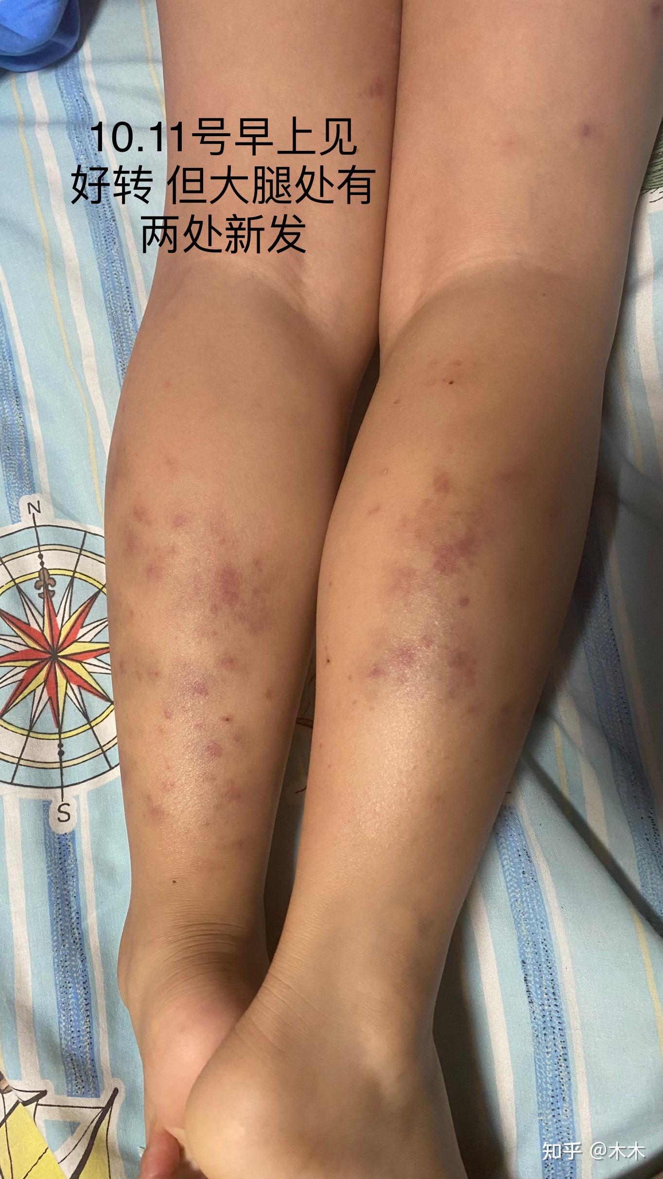 腿上紫癜怎么治疗图片