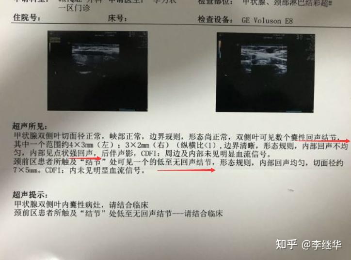 甲狀腺b超中提示無回聲低迴聲強回聲是什麼意思