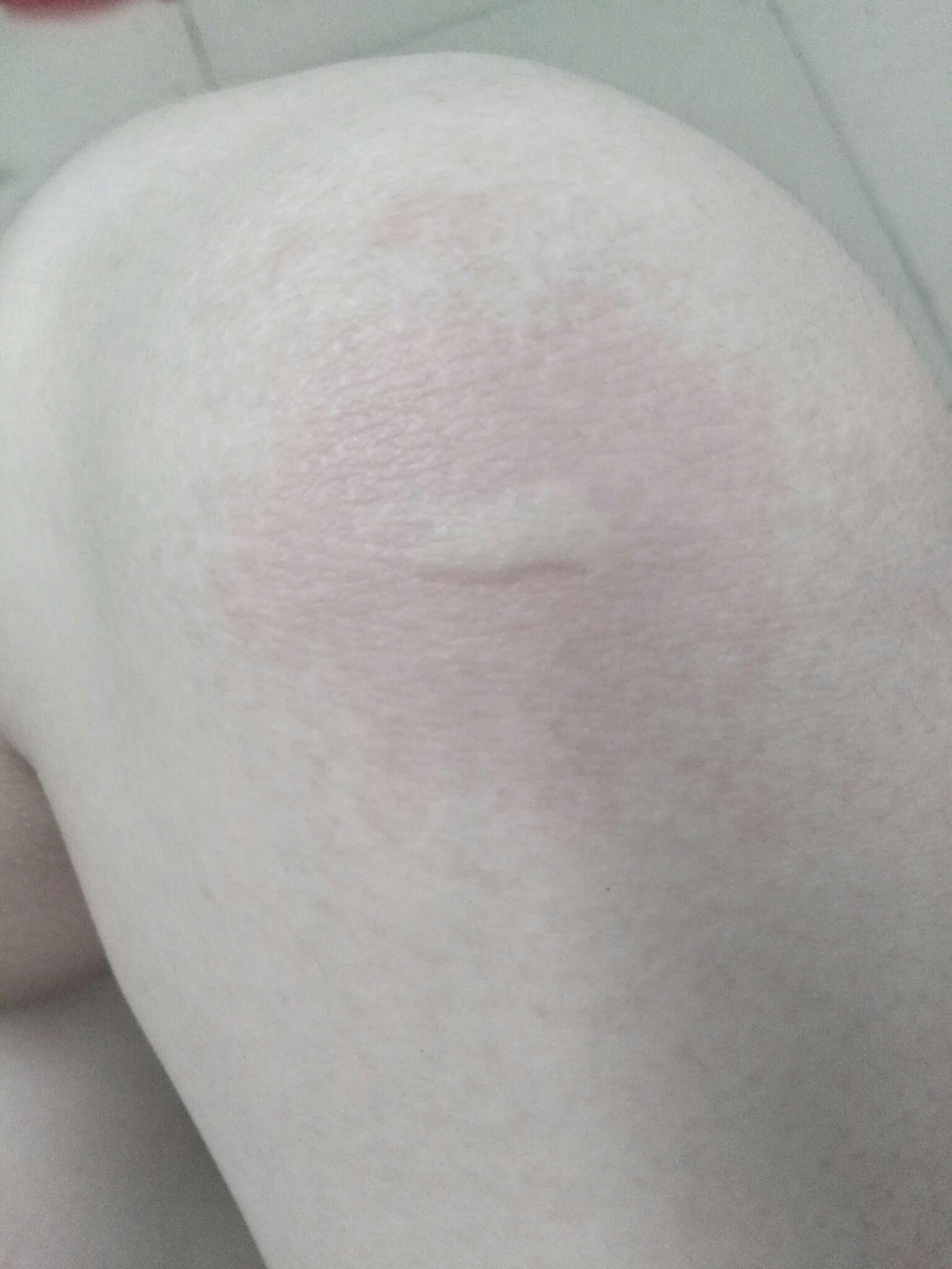 为什么运动时下肢会痒,起包。感觉被蚊子咬的