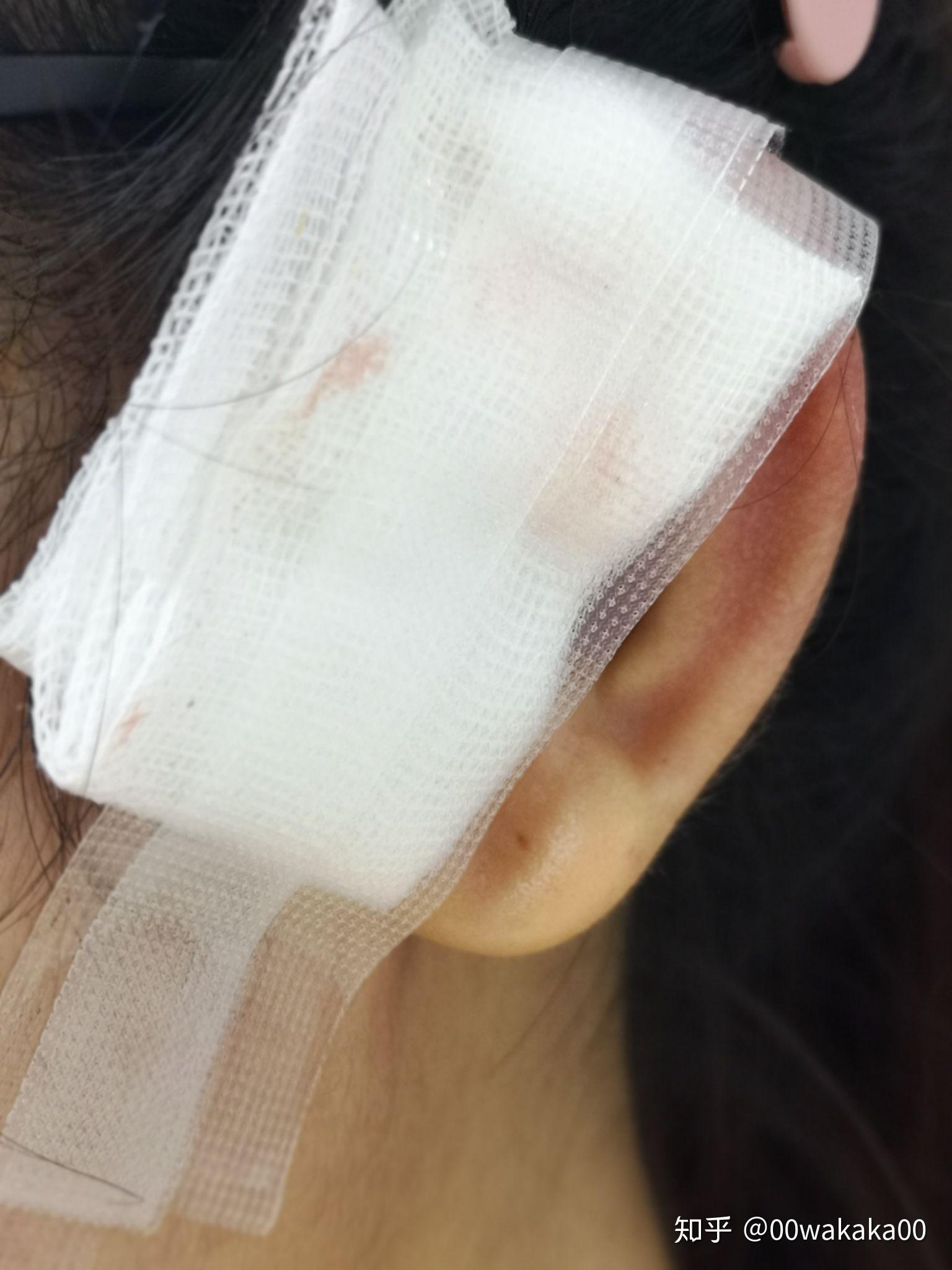 先天性耳前瘘管反复多次手术，为什么还复发 - 好大夫在线