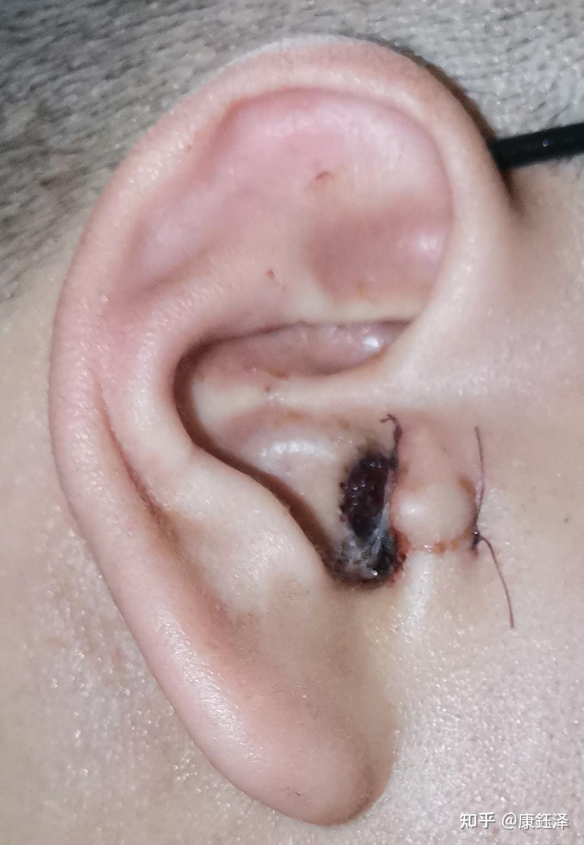 右耳朵鼓膜穿孔15年,终于决定手术修补耳膜了