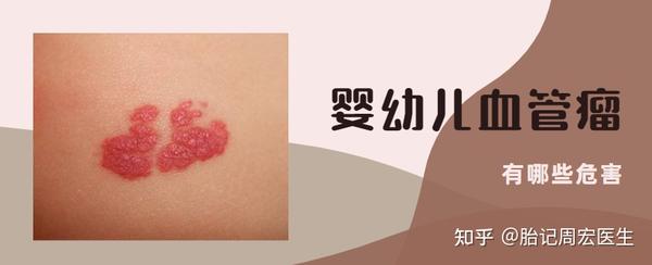 婴幼儿血管瘤存在哪些危害性 - 知乎