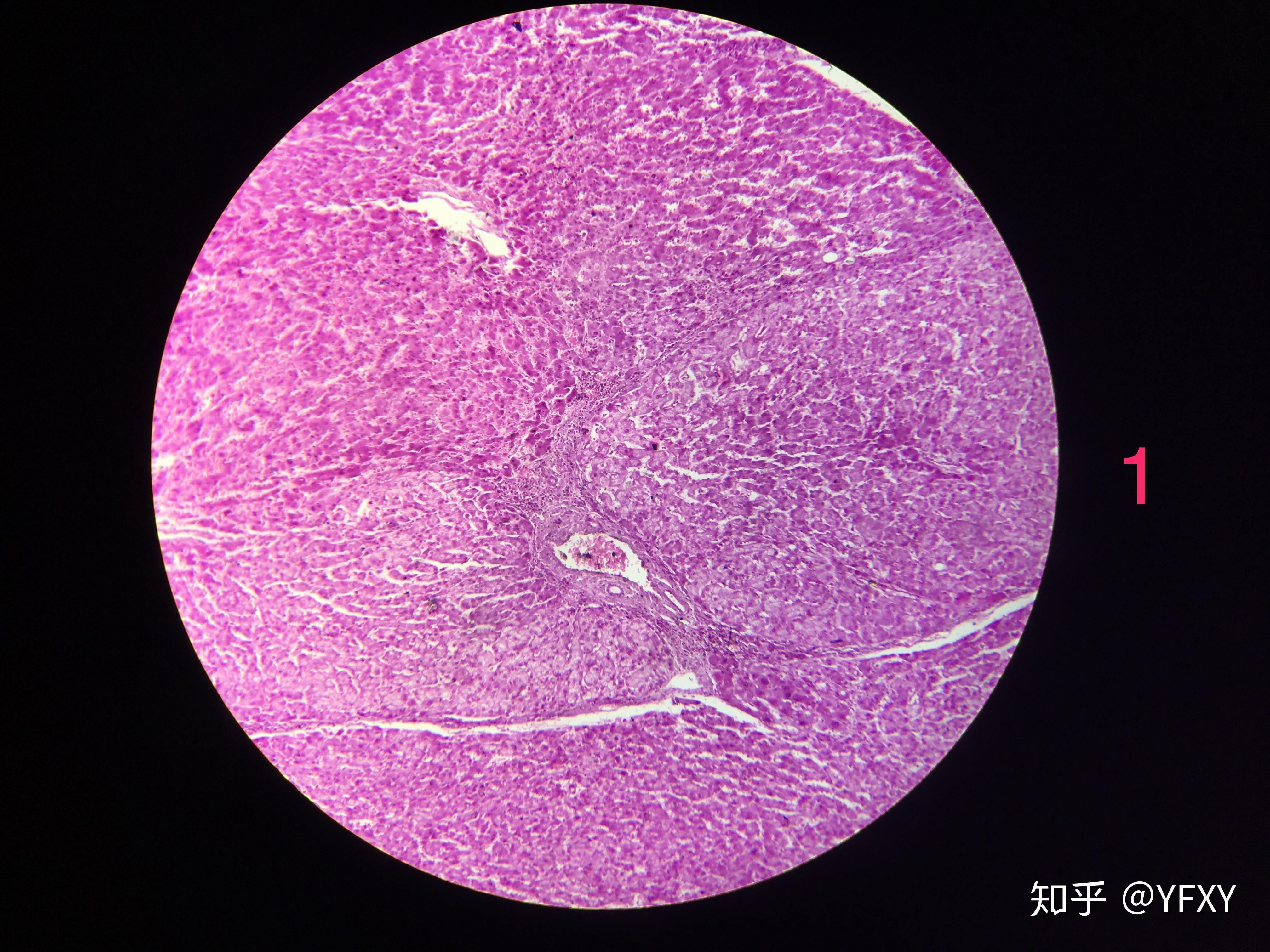 门脉性肝硬化镜下图片图片