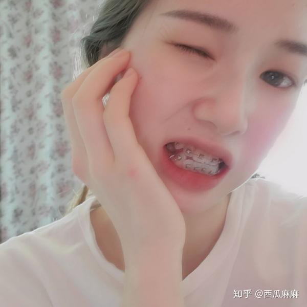 戴牙套是怎样的体验 知乎