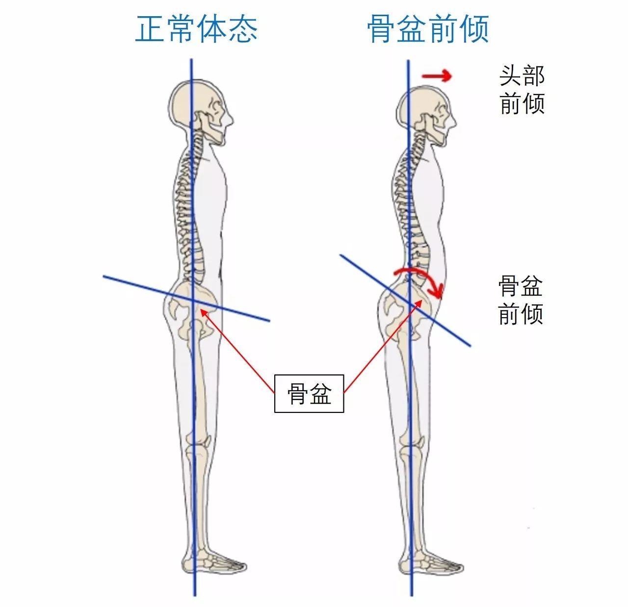 针对慢性腰背痛，符合脊柱曲度的无痛姿势很重要！ - 知乎