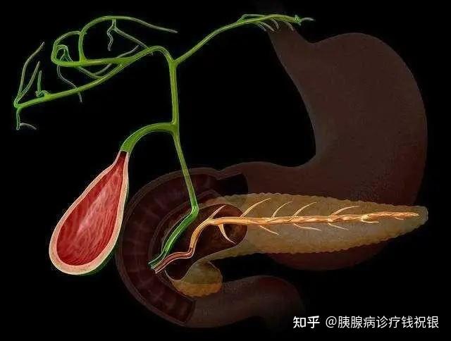 胰腺癌的肿瘤位置及发病特点 - 知乎
