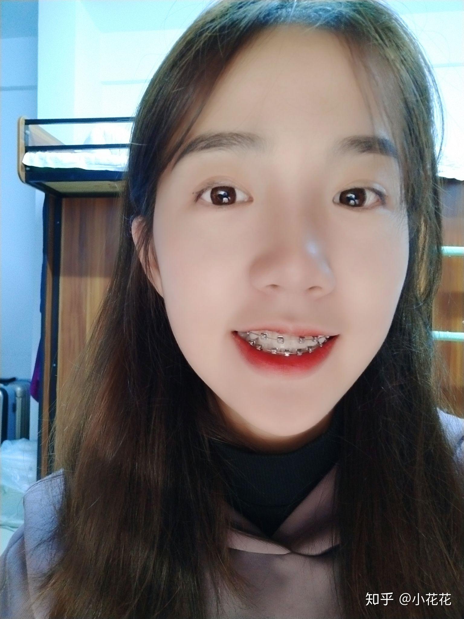 戴牙套的第一天