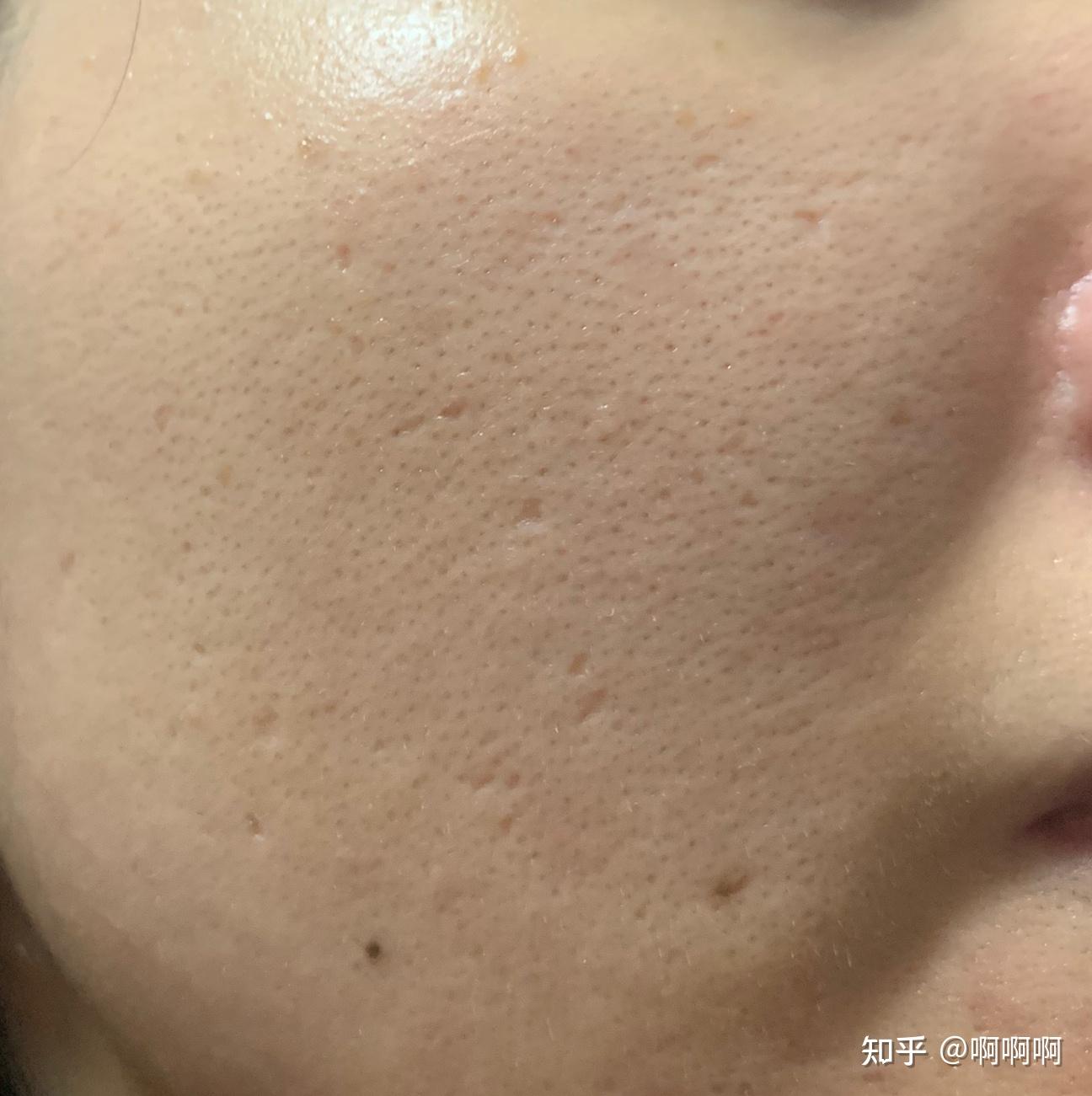第一次非剥脱点阵激光及刷酸