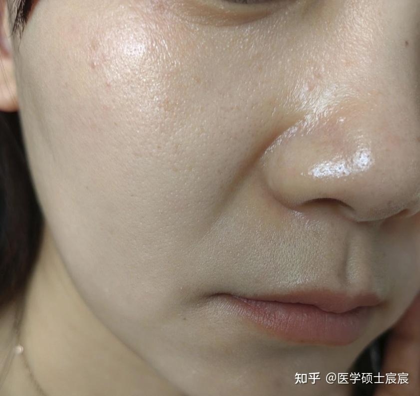 【去法令纹必看】法令纹怎么消除?有什么去法令纹最有效的方法?【医学生分享】28天就能去法令纹的4个步骤,get无痕细腻好皮肤!