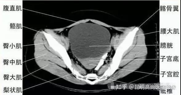 女性盆腔ct,mri检查前如何准备及影像注意什么?【昆明高尚医学影像】