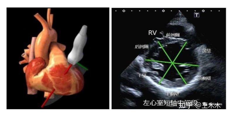 超声心尖五腔心示意图图片