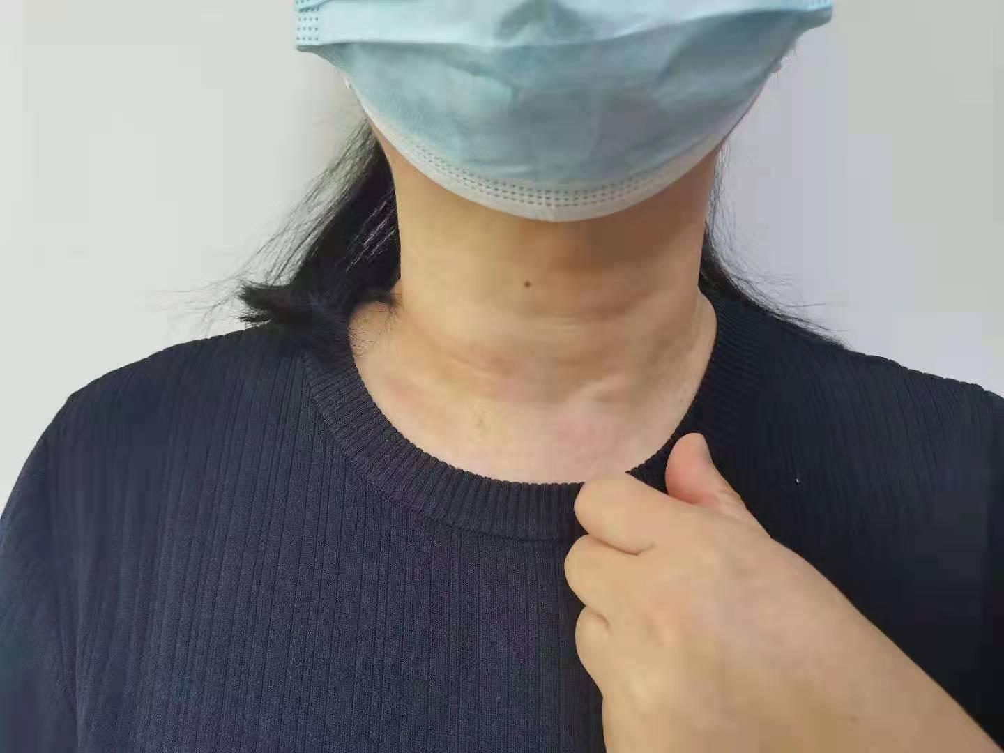 亚急性甲状腺炎的症状