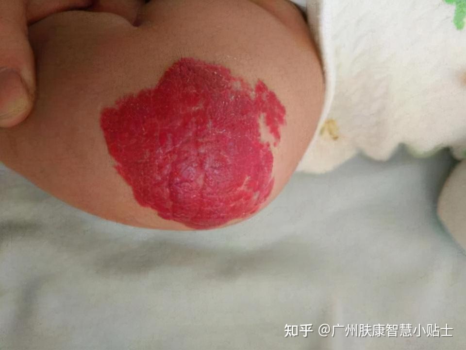 宝宝出生有红色胎记怎么办广州肤康