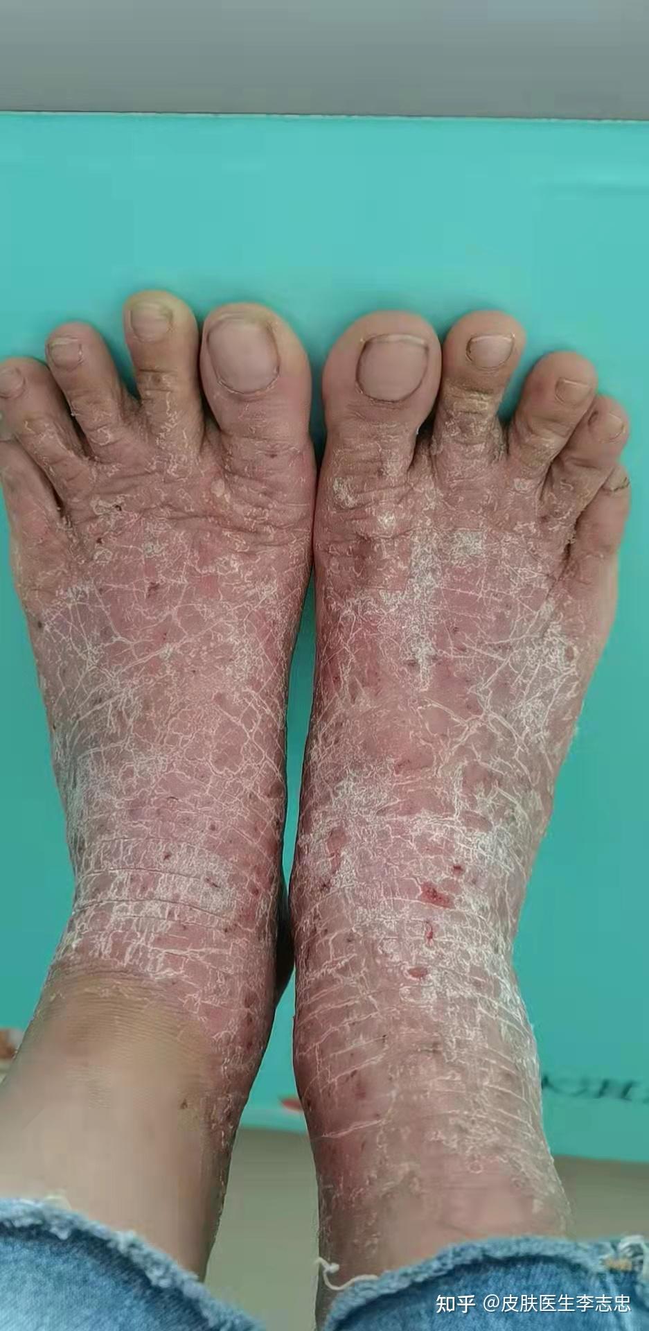 逐瘀化痰方法治疗顽癣医案