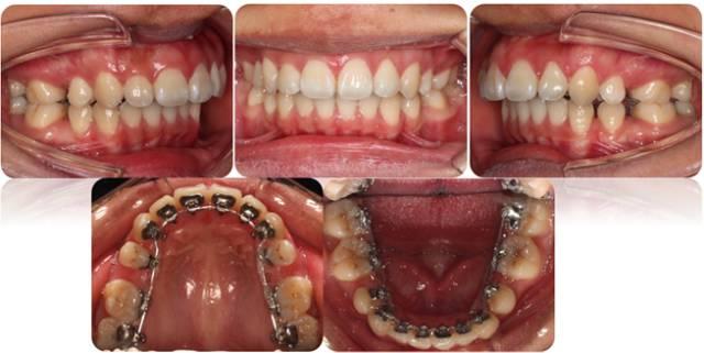 2,正颌手术 3,术后正畸一般严重骨骼畸形,都有不同程度的牙齿代偿,即
