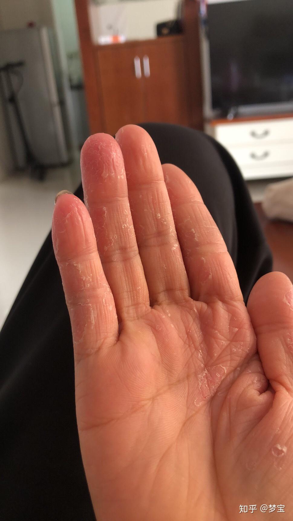 手部湿疹后来演变红斑角化症 正在治疗中 - 知乎