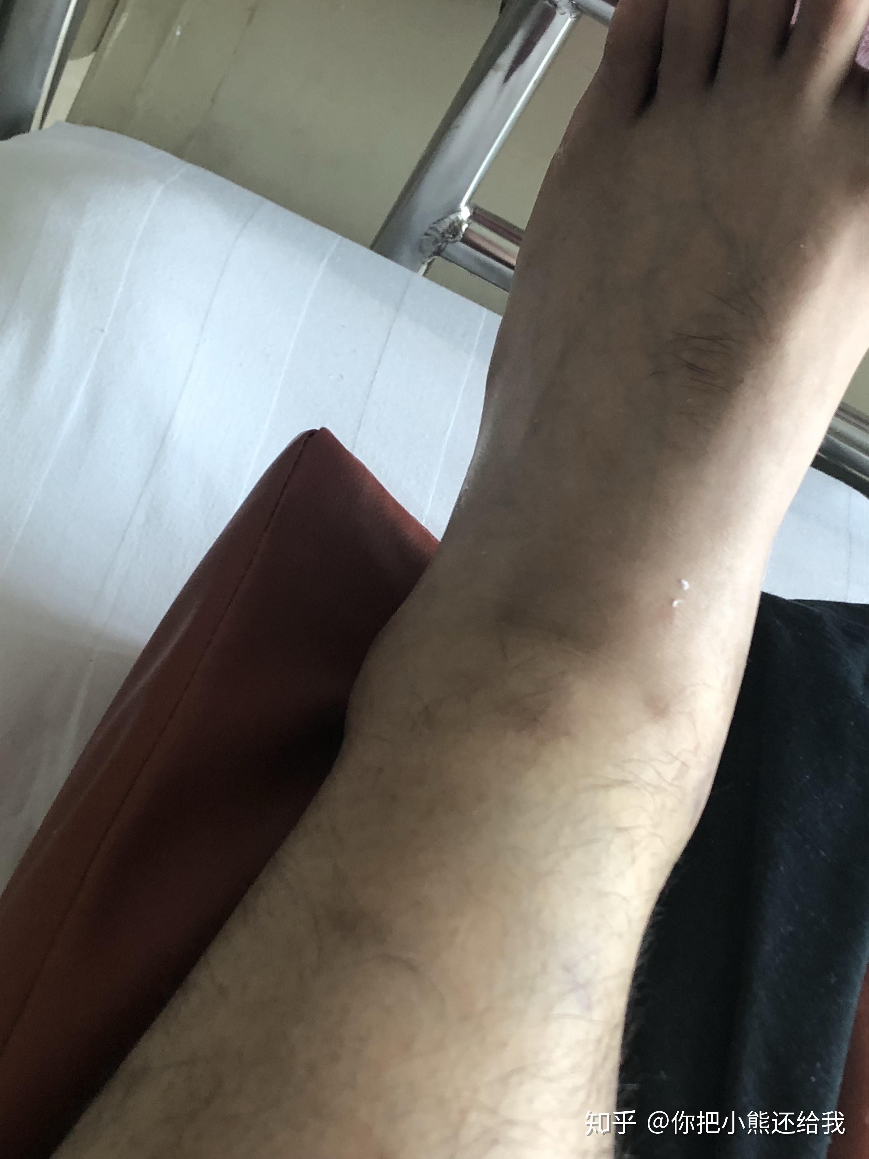 脚内踝骨折 - 知乎