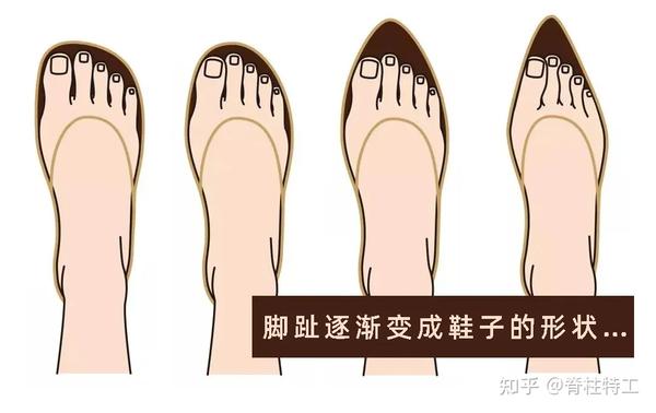 关于『拇外翻』的超全解读！ - 知乎