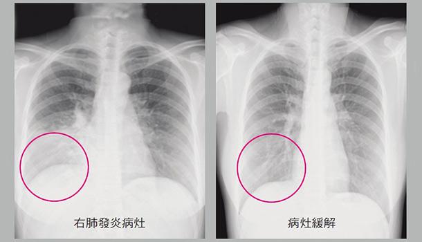 不同颜色的痰液对疾病判断有什么参考意义? - 知乎