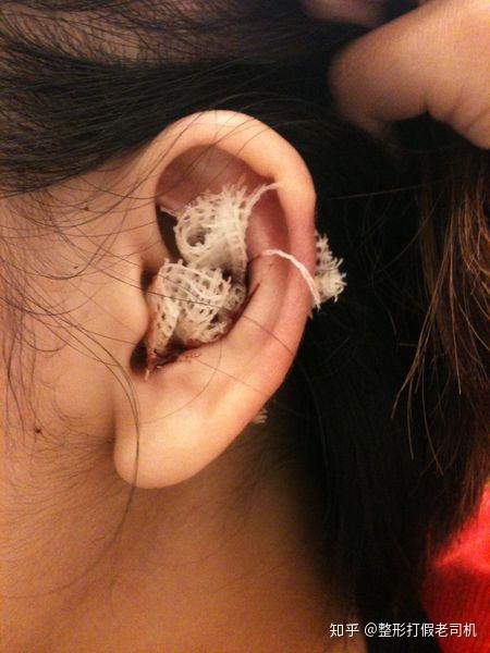 耳软骨隆鼻:是在耳甲艇和耳甲腔处,取一小部分的软骨,保留耳轮脚,保留