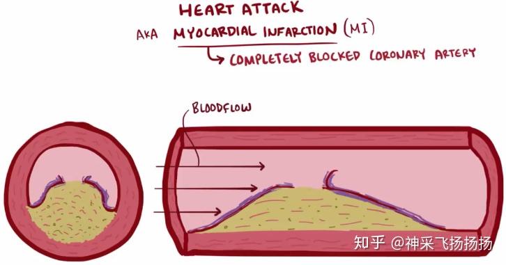 一般具有较软纤维帽的较小斑块,比具有较硬纤维帽的较大斑块,更容易