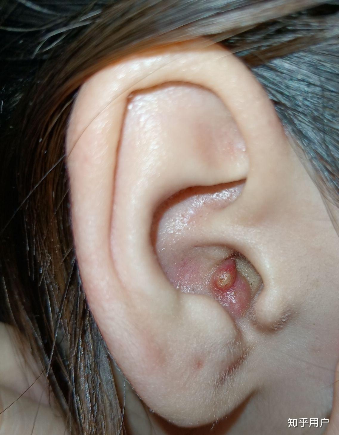 耳朵里长痘痘是一种什么体验