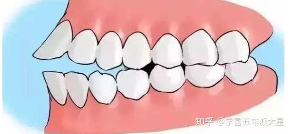 你确定你的牙齿咬合是正常吗？全面详细附图的保姆级纯干货分享 - 知乎