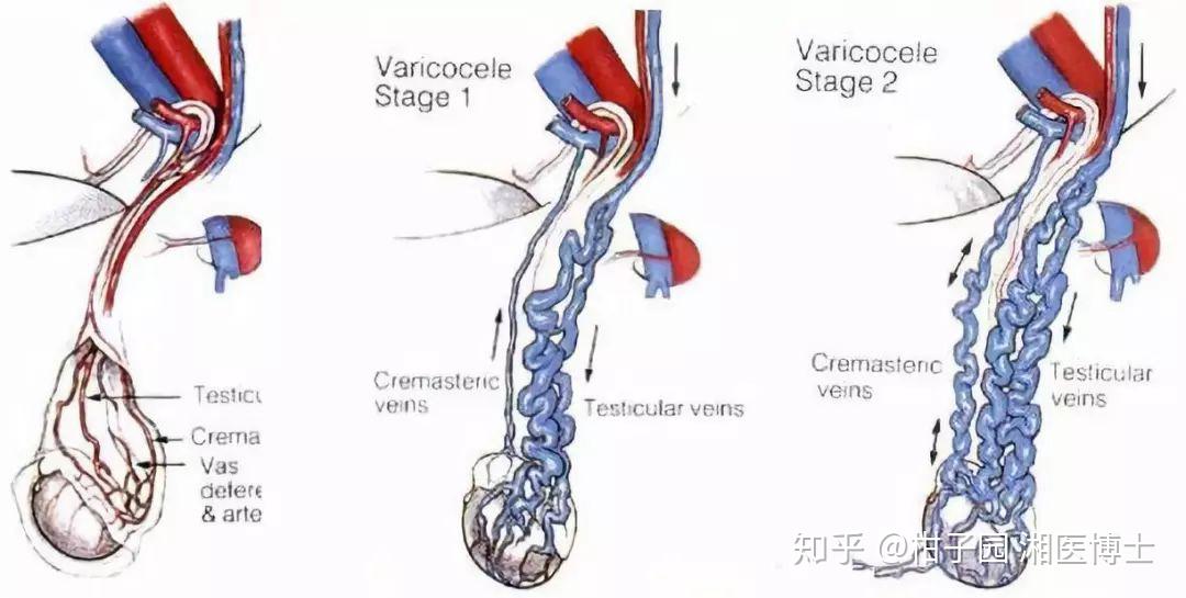 关乎几亿"精子"的大事情---精索静脉曲张