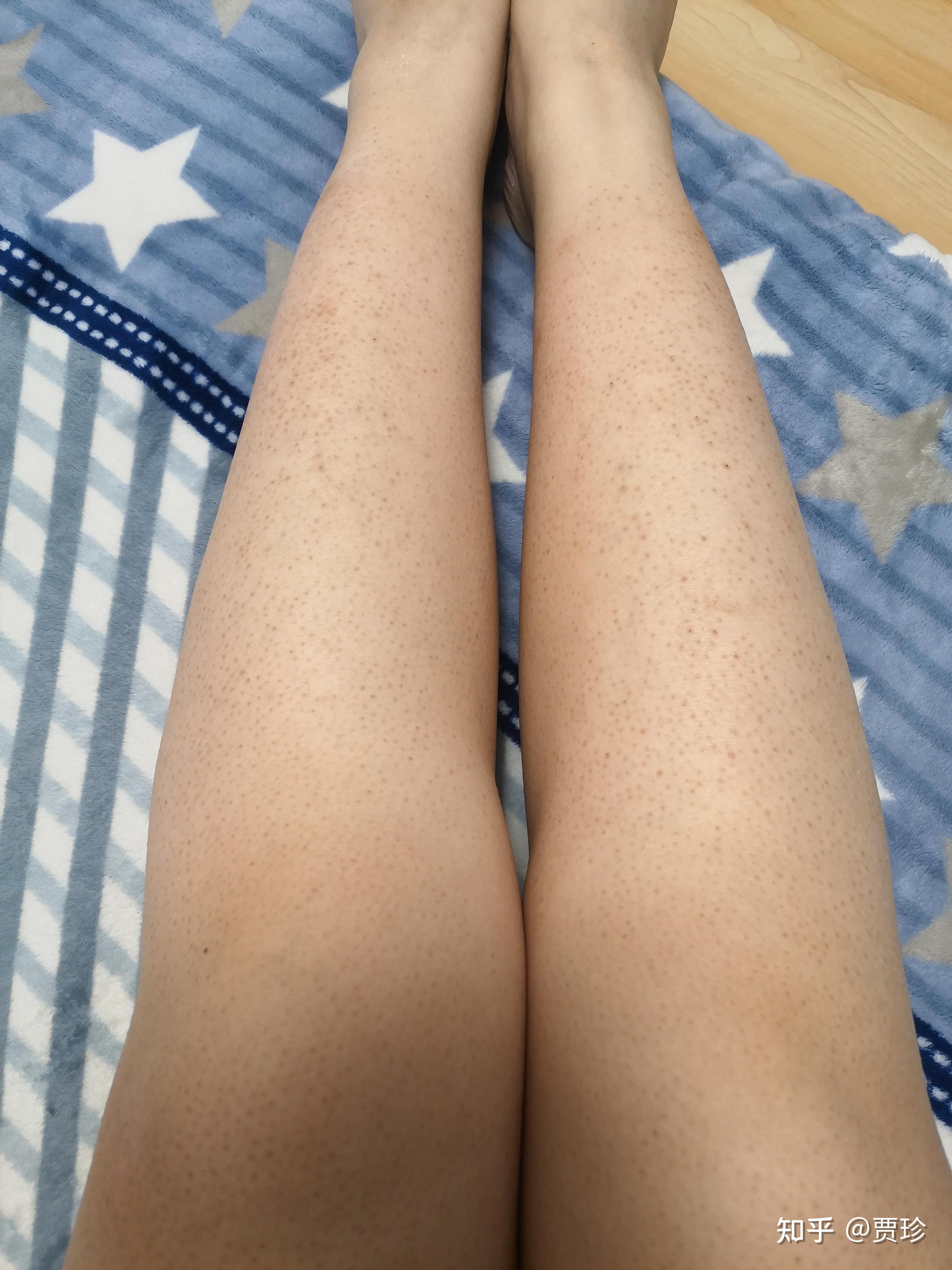 激光脱毛不当引起的鸡皮肤(鸡皮肤激光脱毛会不会有色素沉着)