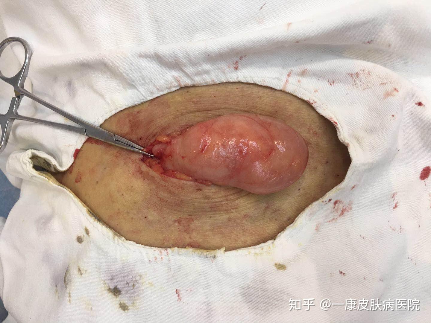 脂肪瘤图片手术过程图片