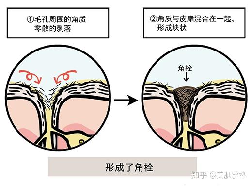 角栓是什么?鼻头毛孔里的白芯到底是什么? - 知乎