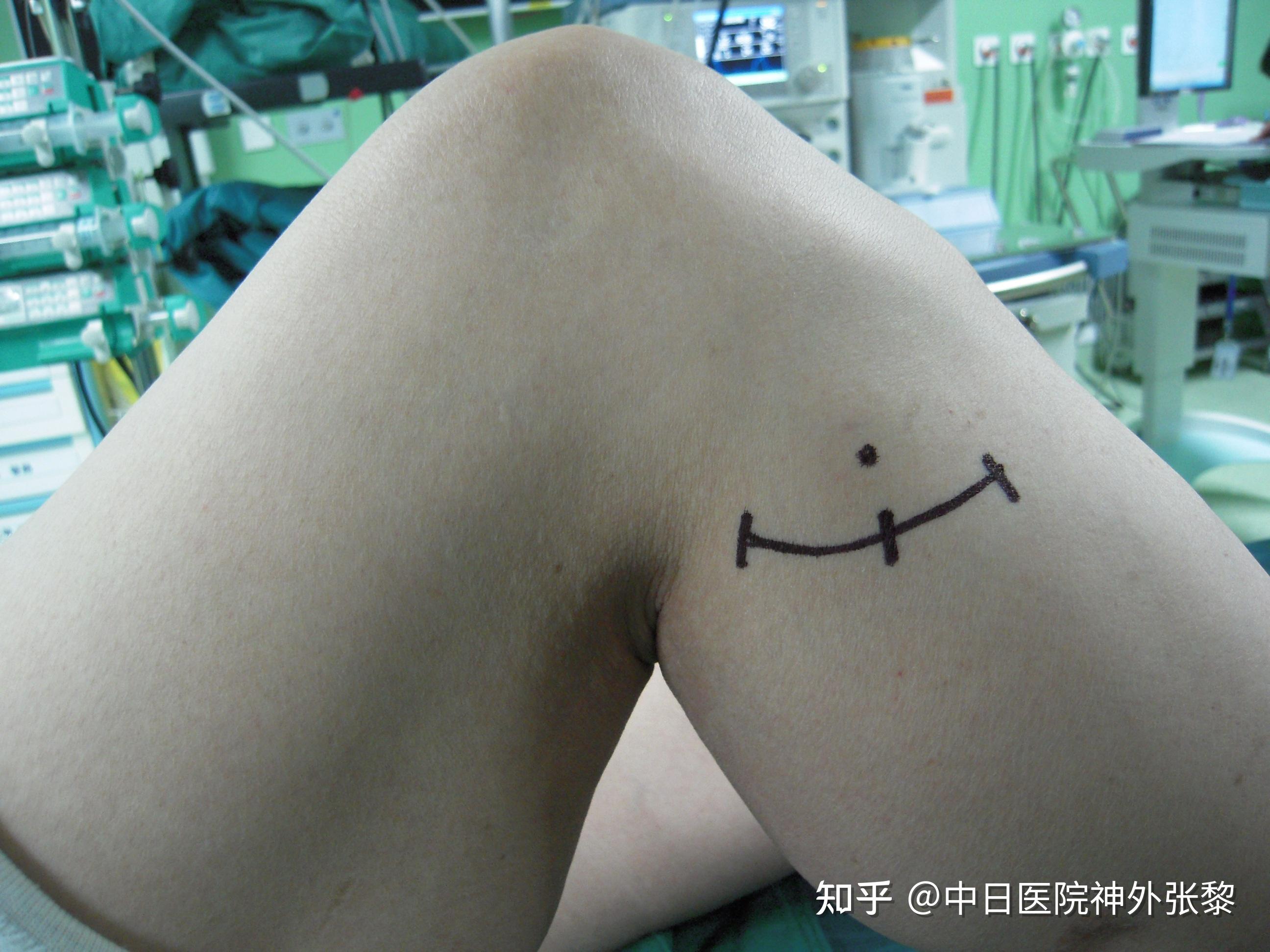 腓总神经卡压综合征有哪些症状?