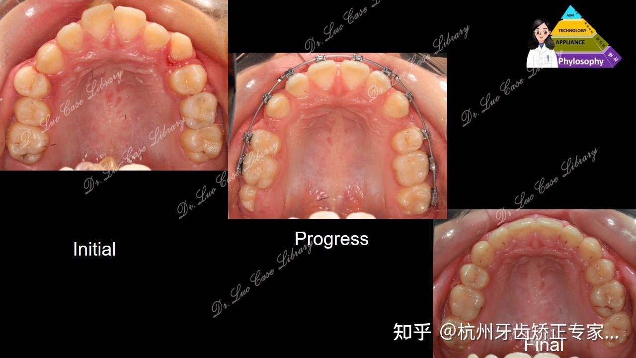 突面型患者的拔牙口外弓矫正