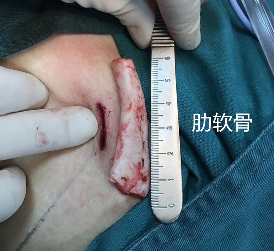 想要隆鼻直鼻水滴鼻和小翘鼻哪种最好看怎么选择合适的隆鼻材料