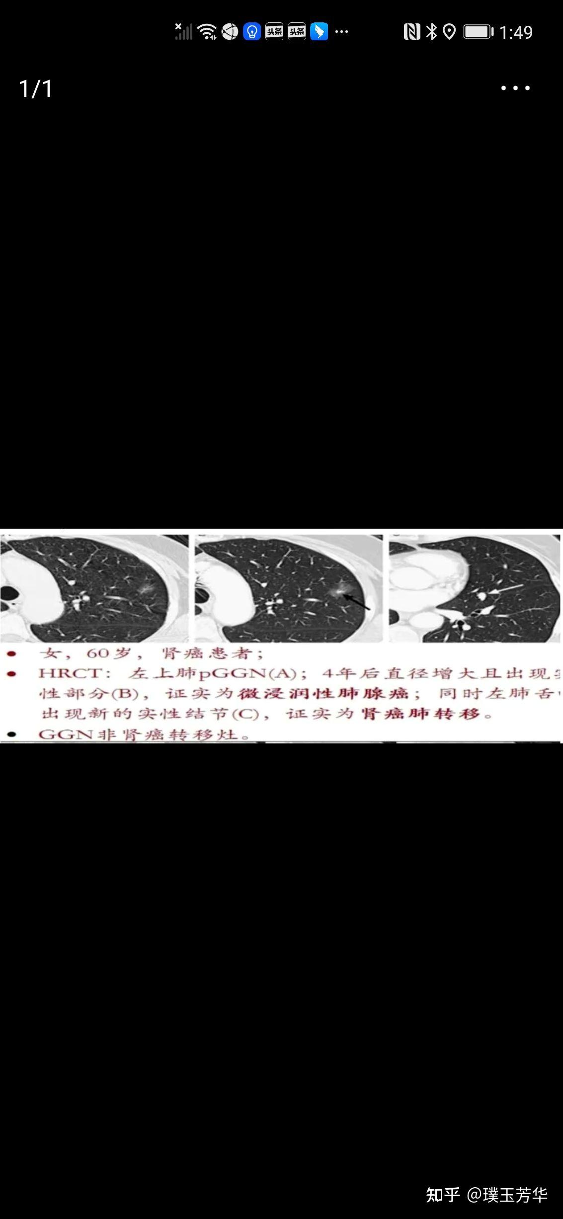 什麼是多發磨玻璃結節雙肺多發磨玻璃結節是肺癌轉移嗎