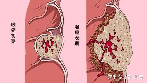 咽喉炎和咽喉癌分不清？预防咽喉癌，这五个预警要记住了！ - 知乎