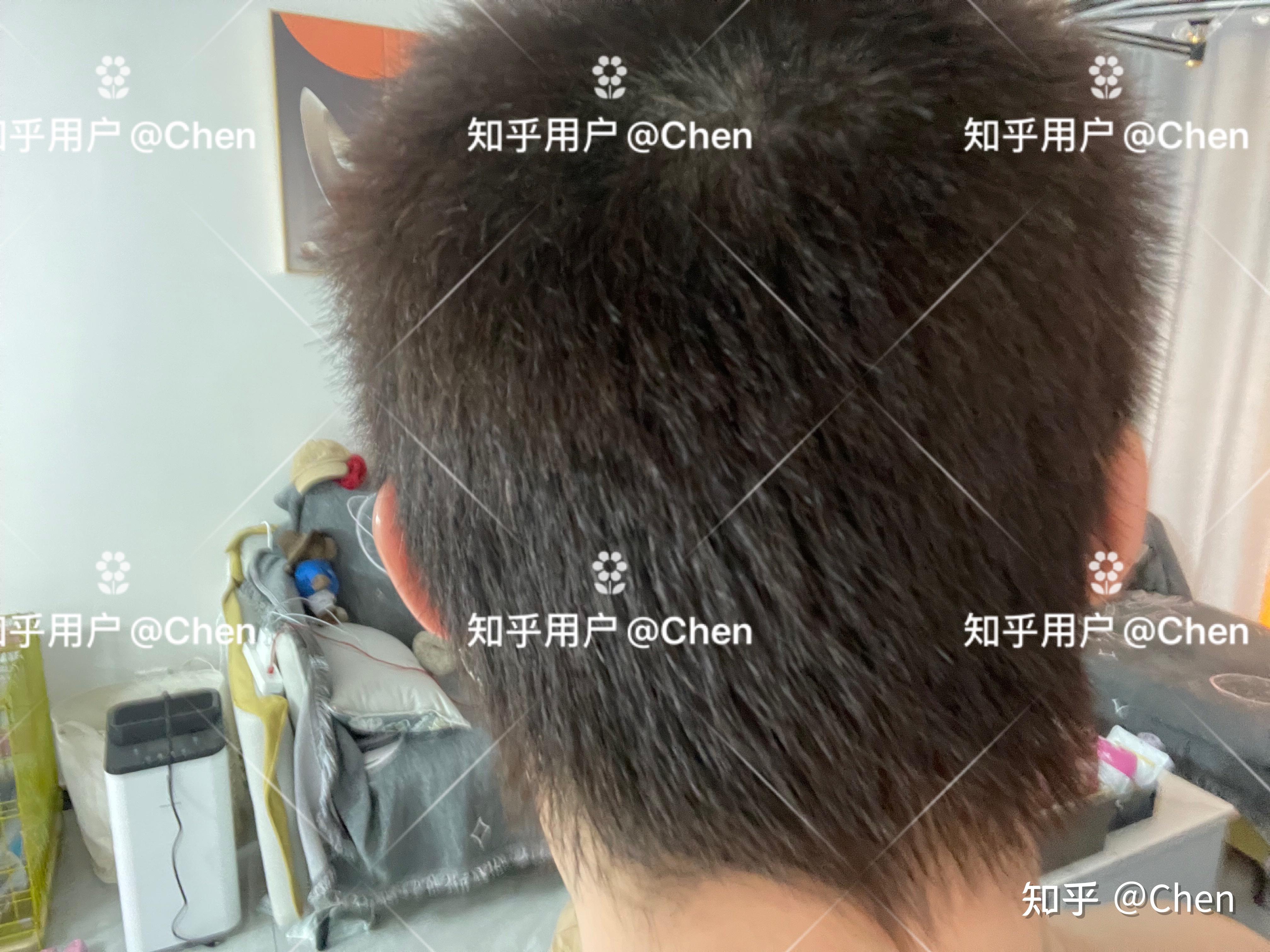 全网植发最多的人(全国植发排名前3位)