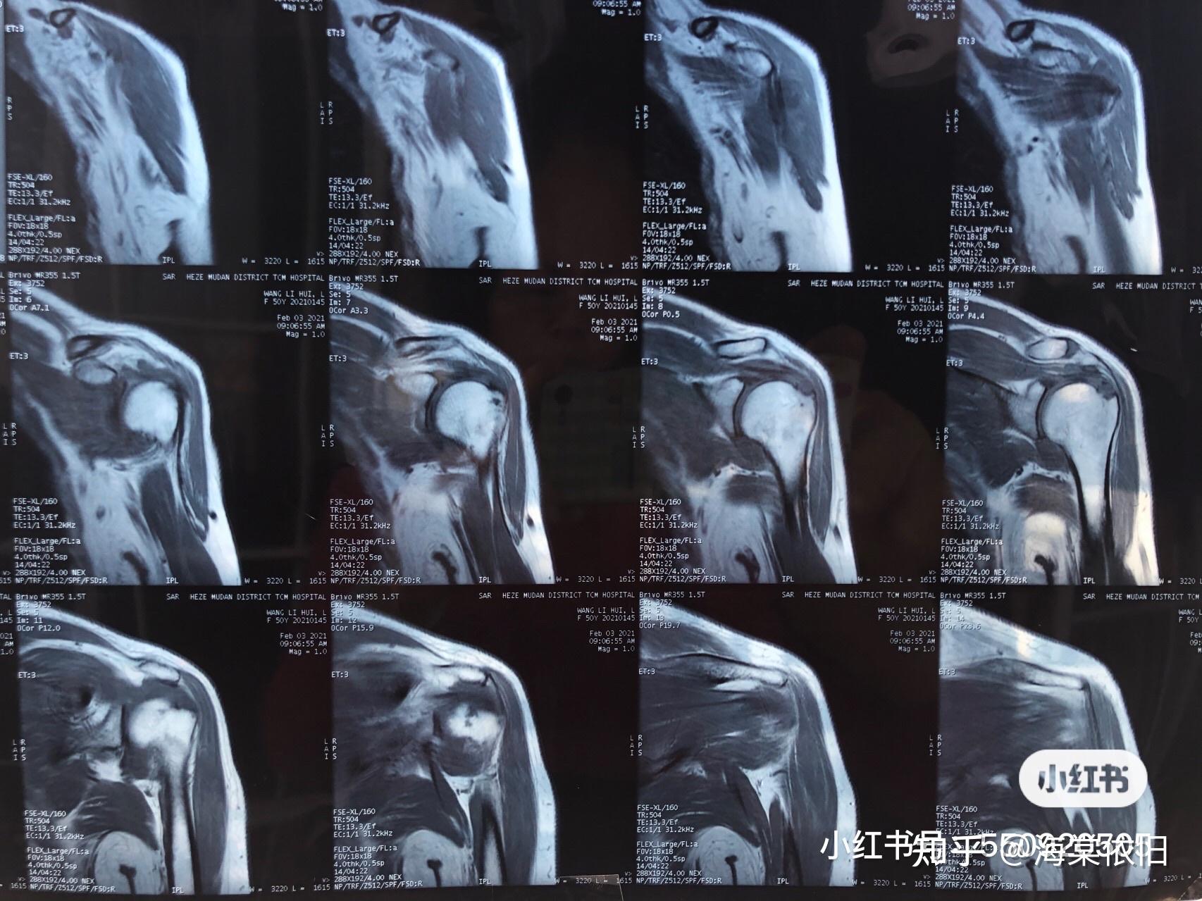 磁共振片子看看骨膜损伤严重吗疼了两个月了晚上休息不好疼醒还几次