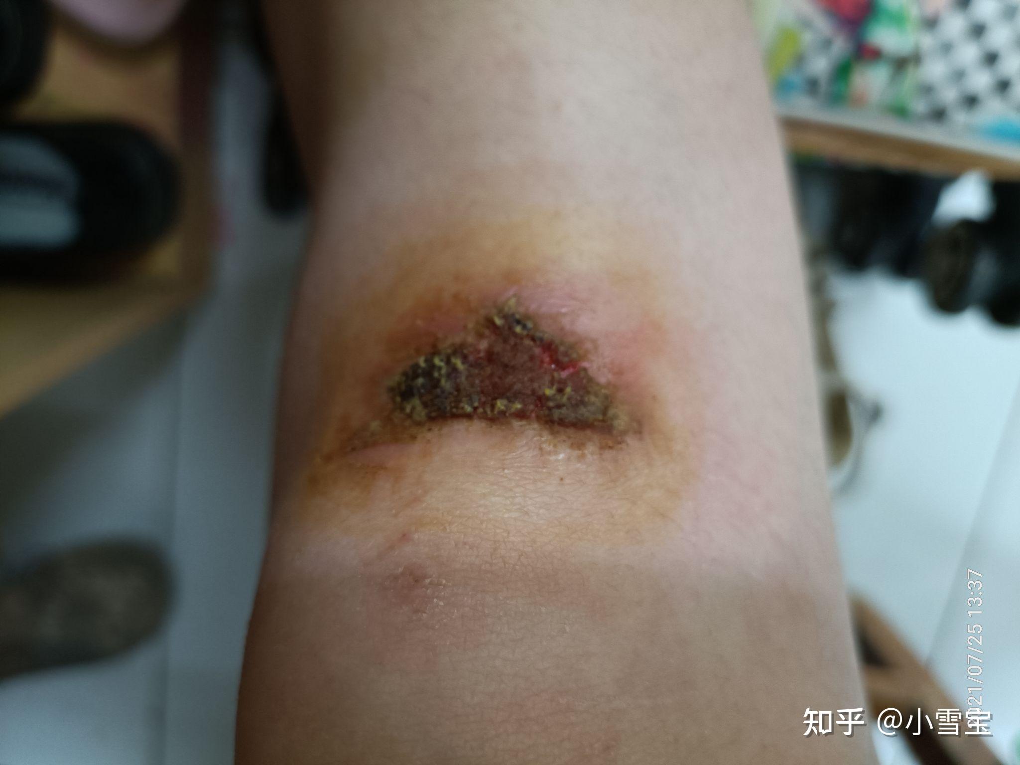 膝盖擦伤到好的整个过程