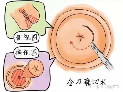 leep刀锥切和冷刀锥切有什么不同?