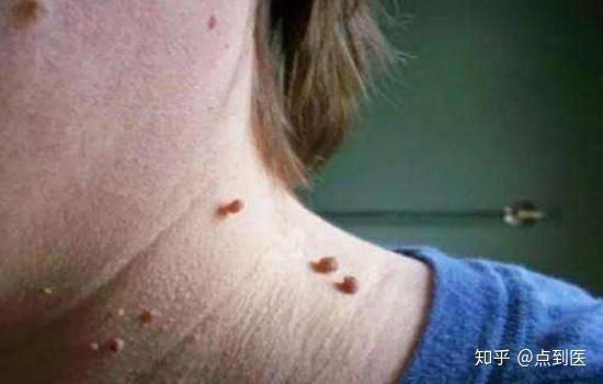 脖子上长疣怎么治 知乎 脖子上长疣怎么治 知乎