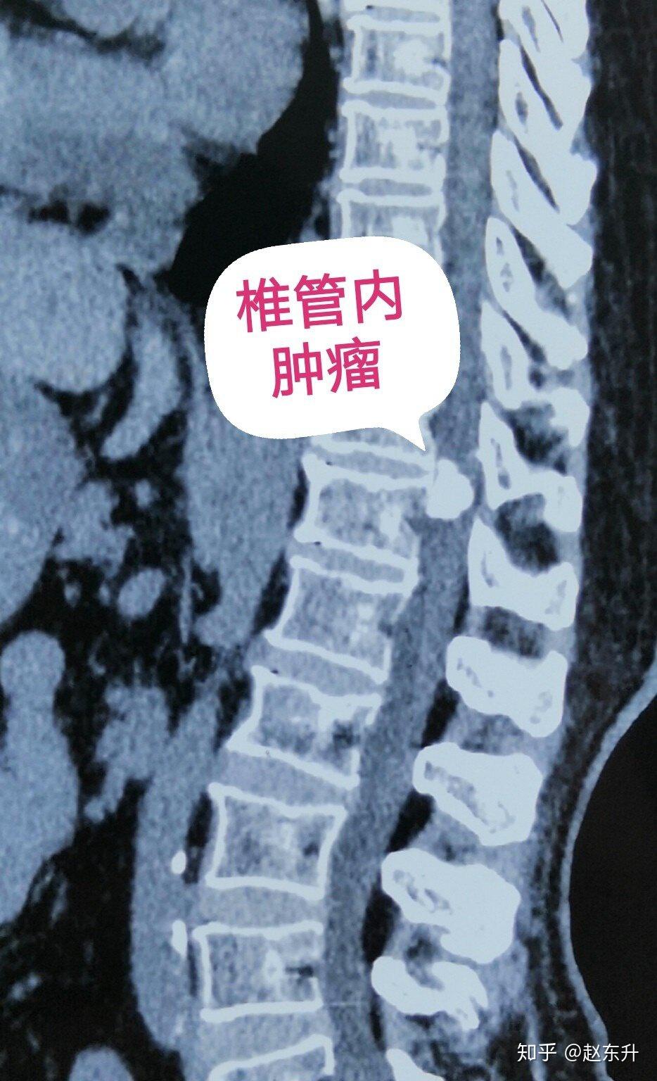 胸腰段ct发现椎管内肿瘤钙化,似骨头一样硬,压迫脊髓明显为了明确肿瘤