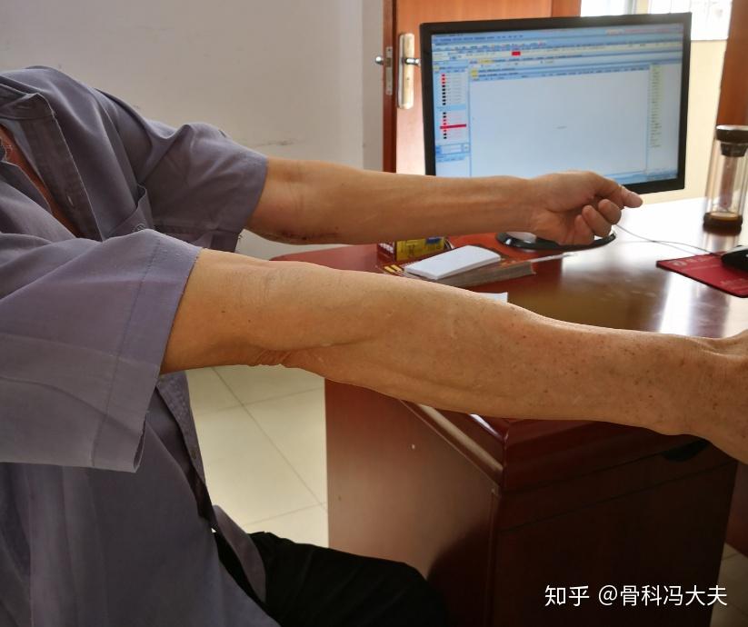 肘关节僵硬强直