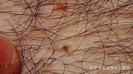 外阴有大颗的痘痘疙瘩,请问是因为上火吗?