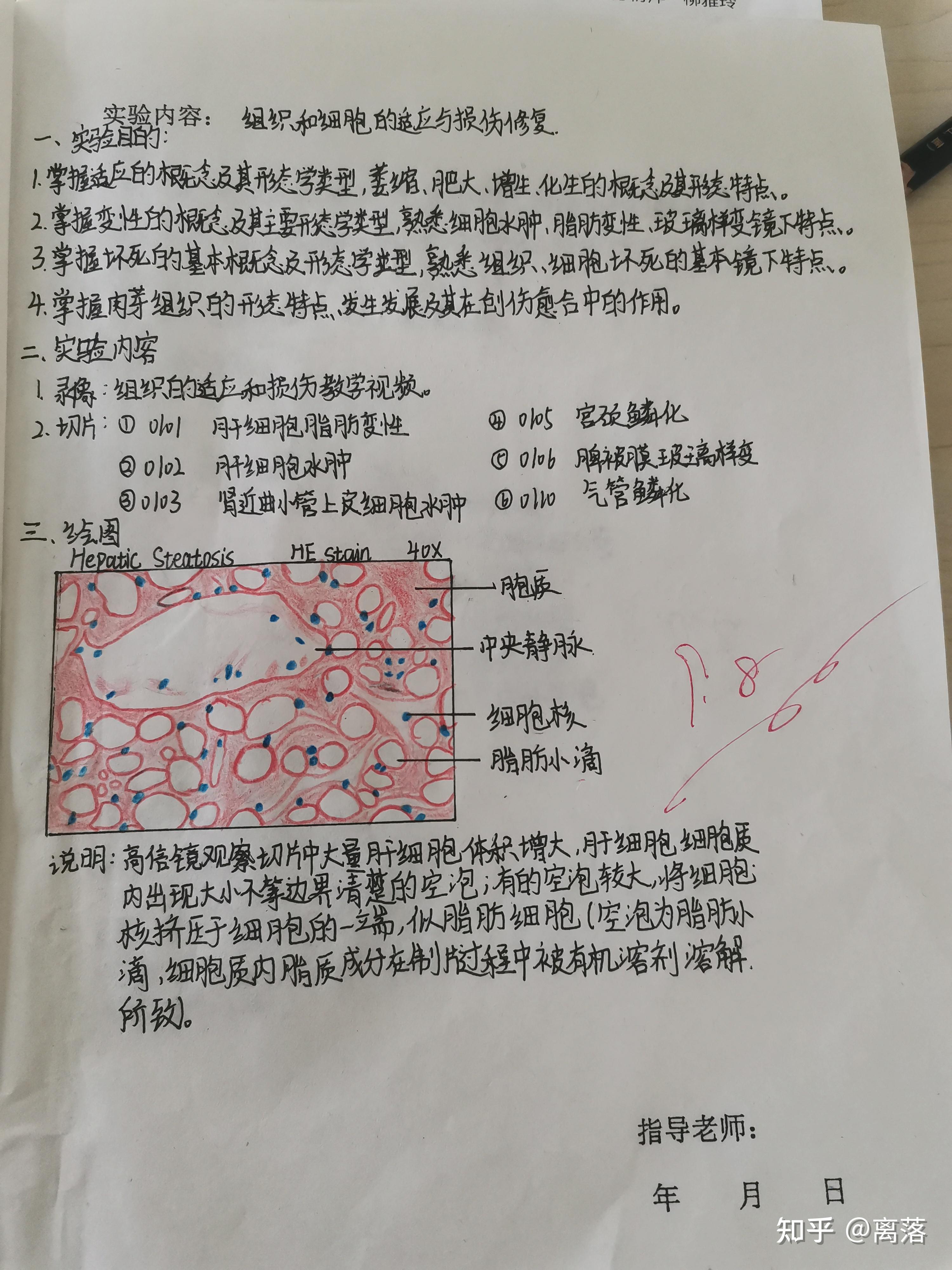 病理红蓝铅笔绘图肝细胞水肿